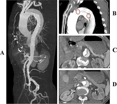 Endoluminal rescue of false lumen graft deployment in TEVAR for type B aortic dissection: a case report and literature review